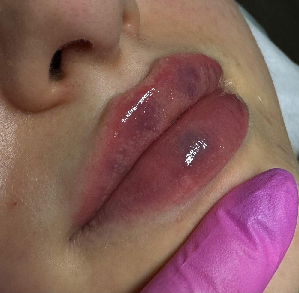 Modelowanie ust Powiększanie ust